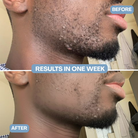 Ingrown Hair Treatment Smoothing Solution