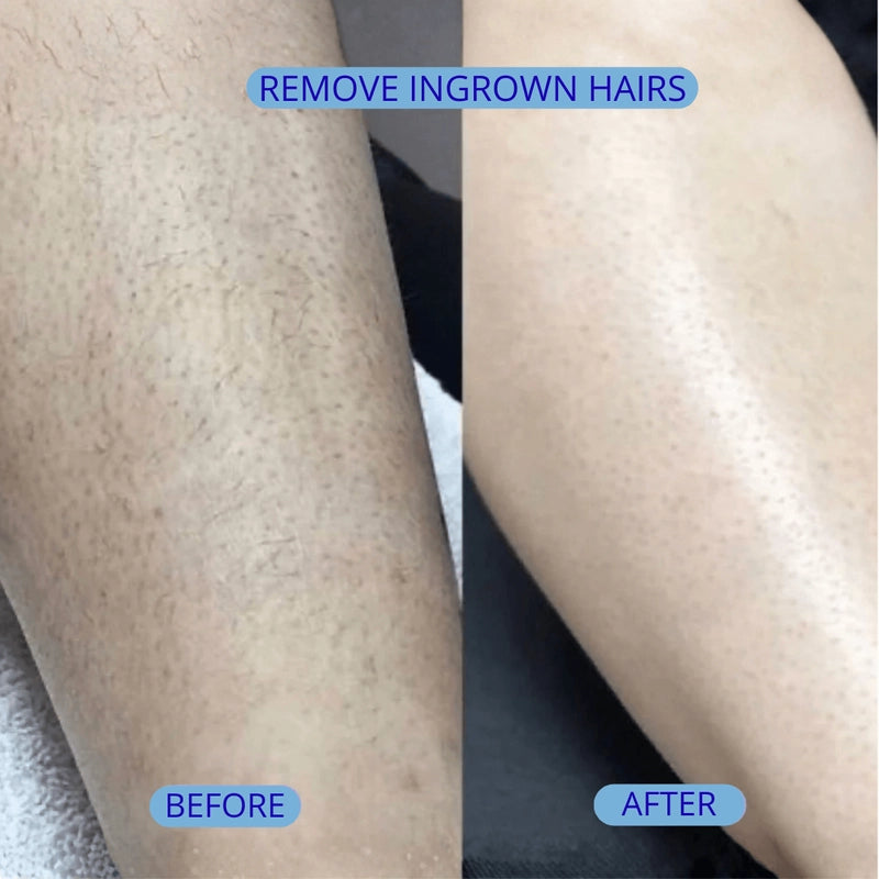 Smoothing Solution Ingrown Hair Treatment
