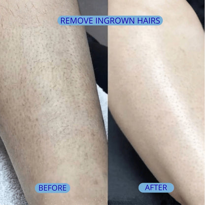 Smoothing Solution Ingrown Hair Treatment