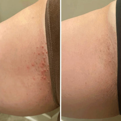 Smoothing Solution Ingrown Hair Treatment