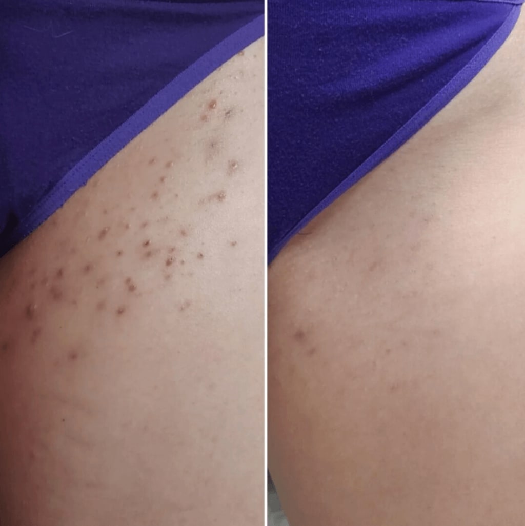 Smoothing Solution Ingrown Hair Treatment