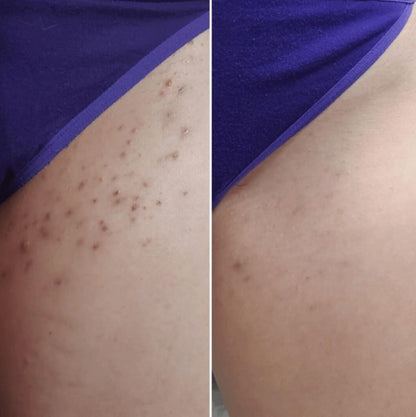 Smoothing Solution Ingrown Hair Treatment