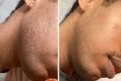 Smoothing Solution Ingrown Hair Treatment