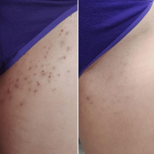 Ingrown Hair Treatment Smoothing Solution