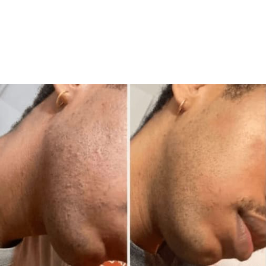 Smoothing Solution Ingrown Hair Treatment
