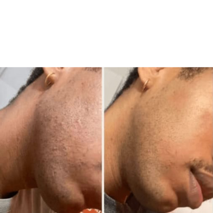 Smoothing Solution Ingrown Hair Treatment